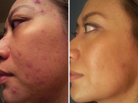 Case Study: Treating Acne with Veritas Bioactives